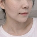 보이다 | 데이터 기반 리프팅? AI핏 미니울쎄라 솔직 후기｜신논현역 피부과