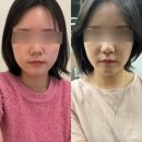 [후기] 쿨소닉 7,000샷 후기 (뷰티라운지의원 대치, 사진 有)