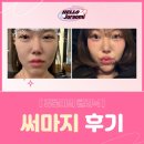 운동공장 | 공장형 병원 써마지, 정말 효과 있을까? :: 내돈내산 후기