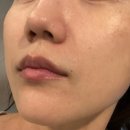 강진수피부과의원 | 교대 피부과 정품이온자임 미백관리 후기