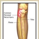 총비골 신경 (common peroneal nerve) 1 이미지