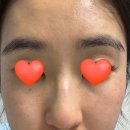 부산한의원 | 편평사마귀 제거 잘하는 곳 하늘체한의원 부산점 내돈내산 솔직후기