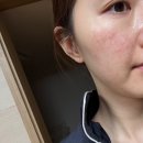 광주동운한방병원 | 부산 서면 피부 리프팅 추천 ㅣ튠페이스 통증 및 리얼 후기