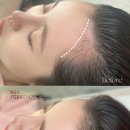 선헤어라인 이미지