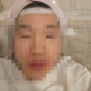 연산트레이더스약국 | [내돈내산] 부산 연제구 연산동 이마트 트레이더스 연산점 미소의원 헤어라인 레이저 시술 후기입니다.