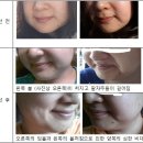 매선 부작용 후기. 매선 (한방 실리프팅) 절대 하지 마세요 이미지