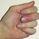 동송제일정형외과의원 | 마천 오렌지정형외과의원 후기(feat.생인손)