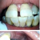 저스트임플란트치아연구소 | 임플란트·보철치료 고민된다면? 전농동치과 엘치과병원 실제 치료 후기 확인하세요