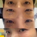 눈밑지방재배치 멍, 가격, 부작용 모음 연예인 부터 30대 지인 후기까지