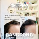 [아트라인] 강동구 M자 이마 SMP, 내머리 같은 자연스러운 헤어라인 후기 (구 올가뷰티)