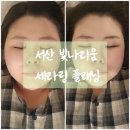 서산 피부관리 피지관리 세라링 스킨플래닝 빛나리움