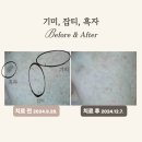 광교고운꿈피부과의원 | 수원 잡티 제거 피부과, 기미 제거와 차이점!