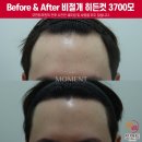 3700 | 30대 남성 M자탈모 중앙부 비절개히든컷 모발이식 3700모 12개월 후기
