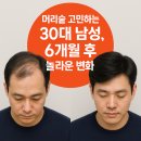 동명한방병원 | 머리숱 고민하는 30대 남성, 6개월 후 놀라운 변화! [동명정환 후기]