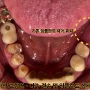 에스(S)치과기공소 | 달서구 임플란트 치과 타 병원 임플란트 실패, 앞니 레진 잦은 탈락