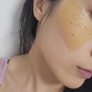 라온약국 | 수원 인계동 기미잡티제거 제로스팟으로 이젠 안녕