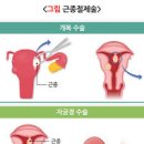 자궁근종 통증 발생원인 알아보기 이미지