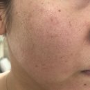 올리미의원 | [압구정 올리미] 아기레이저 후기 :)