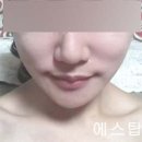 에스탑성형피부 네이버블로그