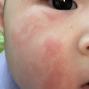 지아란파트너스 | 아기 아토피 크림 후기, 밤마다 긁던 지아가 달라졌어요