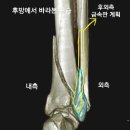 60대 환자의 정강이뼈 골절, 원위 경비골 골절 (Distal tibiofibular fracture) 금속판을 이용한 수술...