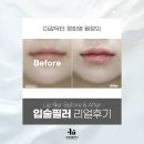 닥터(Dr.)초이 피부과의원 | 압구정피부과 이유클리닉 입술필러 입술 두께의 이상적인 비율은? 전후 비교분석