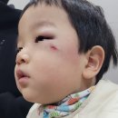 웰손병원 | 만4세 아들 침대 프레임사고, 눈밑 광대뼈 봉합 수술후기