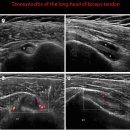 Tenosynovitis of the long head of biceps tendon 이미지