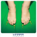 발가락 단지증 수술 ＜ 다발성 ＞ case 506 이미지