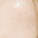 메디칼바른약국 | 천안 델뮤즈 편평사마귀 제거 솔직한 후기