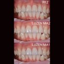 공간덴탈치과기공소 | 치과기공소 | 11·21 중절치 PFZ vs 풀지르코니아 비교, A1 A2 쉐이드 셋팅 케이스