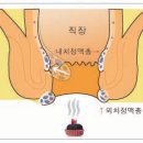 🍁No.496.치질과 한방요법 이미지