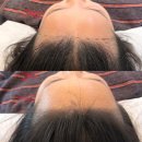 창원 마산 가르마, 헤어라인 시술 잘하는 곳｜주상가 오드리햅번 솔직후기!
