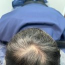 더온(THEON) | [경북/포항] 남자 탈모 커버 SMP 더온뷰티끄 솔직한 후기