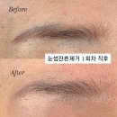 인계동 919 | 수원 인계동 눈썹잔흔제거 리얼 후기 (1회차에 벌써 깨끗해진 눈썹)