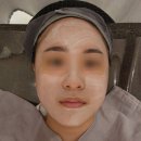 필한의원 | 천안여드름전문한의원 흉터치료 8회차 후기 새살필 내돈내산