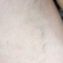 진주항맥외과의원 | [진주 하지정맥류]가좌동 항맥외과의원_하지정맥류 초음파