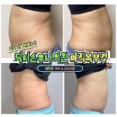 닥터올린의원 | 강남 지방분해주사 닥터손유나의원 매직복부캣 매직캣1회차 후기 (복부, 러브핸들)