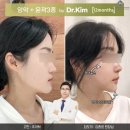 김종윤 | 양악수술방법 비대칭턱 양악후기 절차 과정 순서