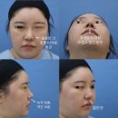미작의원 | 코재수술 후기｜뭉뚱한 코끝·비주 디자인과 기능 교정 동시 진행