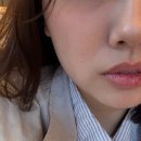 강남우태하피부과의원 | 강남역 피부과 온다 리프팅 후기, <베러미 의원 강남점> 땅콩형 얼굴 디자인 잘해주는 곳