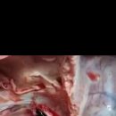 백신 접종후 뇌혈전증으로 사망한 사망의 뇌 부검(영상) 이미지
