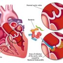 감염성 심내막염[infective endocarditis]이란? 이미지