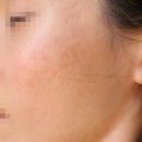 성인여드름 한의원 반복되는 트러블 관리해요