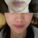 소정약국 | 약국 여드름 흉터 연고 추천 / 사용법 / 내돈내산 한달후기