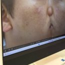 자연과한의원(대구점) | 대구흉터치료 새살침 여드름한의원 후기, 남자 여드름흉터 치료 내돈내산 후기