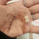 하얀치과의원 | 매복치 발견 후 교정치과 견적 및 교정중 후기(하얀림치과 가지런이치과교정과 치과의원)