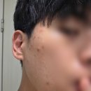 여드름성 피부완화 기능성 폼클렌징 엔비솔루션 추천 단기간 사용 후기