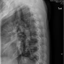 Thoracic Spine Lateral 이미지