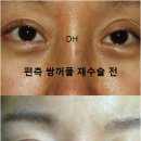 두한성형외과 진솔 후기